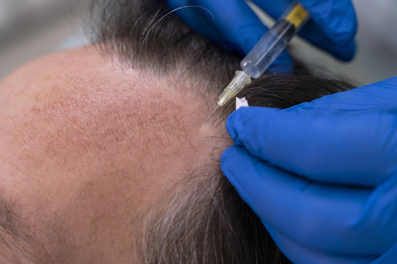 Scalp micropigmentation vs hair transplant