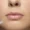 lip-pigmentation-treatment-cost-in-india-expert-solutions-1