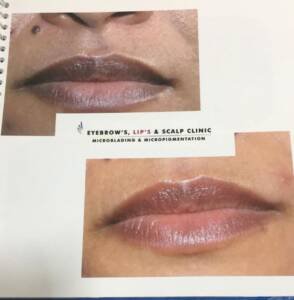 Lip Pigmentation Results