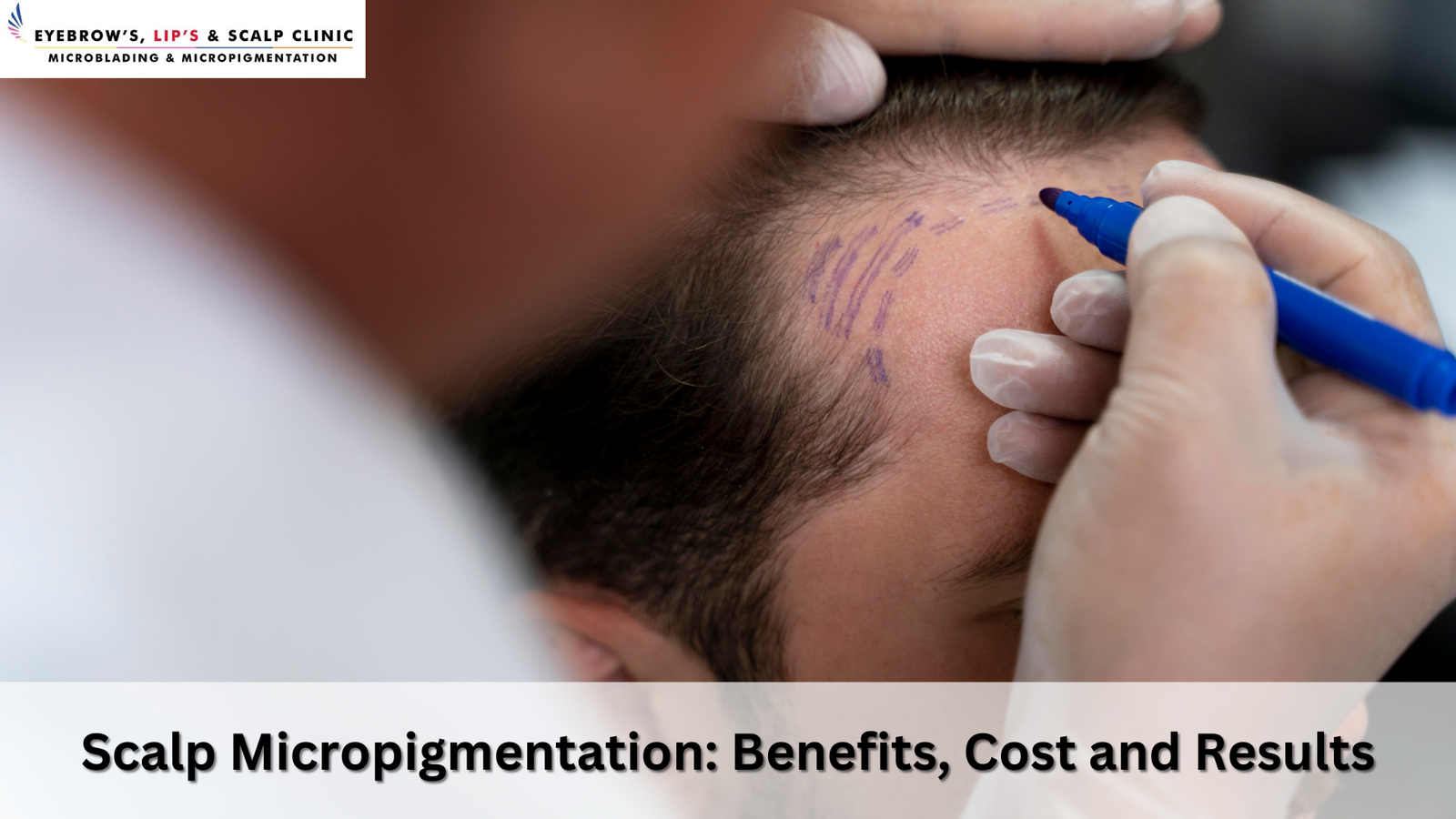 Scalp Micropigmentation Benefits, Cost and Results