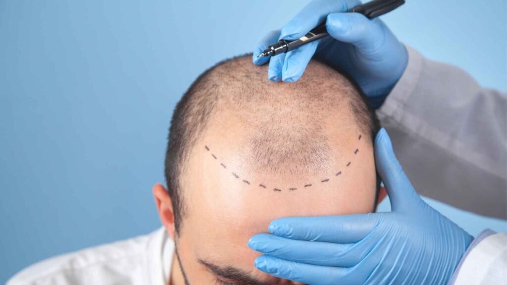 scalp-micropigmentation