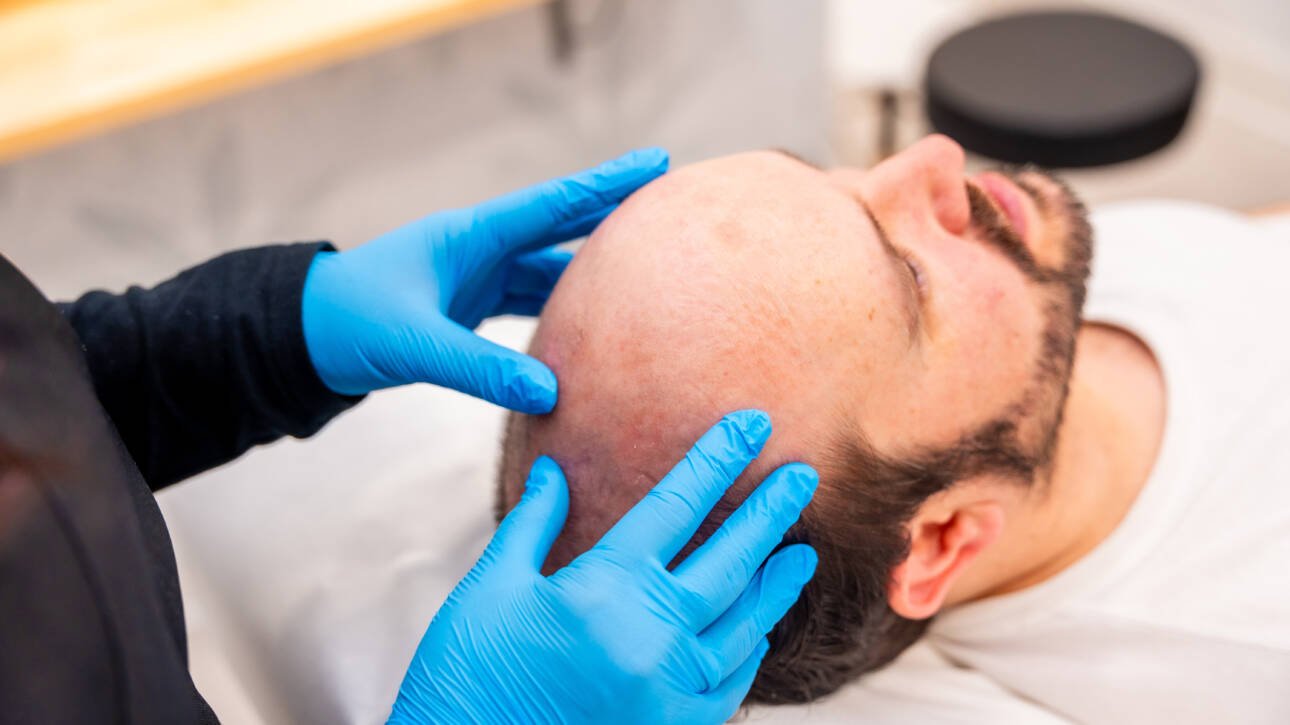 Pros and Cons of Choosing Scalp Micropigmentation