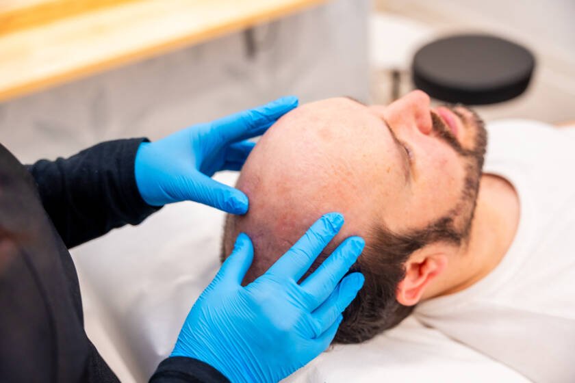 Pros and Cons of Choosing Scalp Micropigmentation