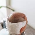 Can Scalp Micropigmentation Be Removed? Exploring Your Options