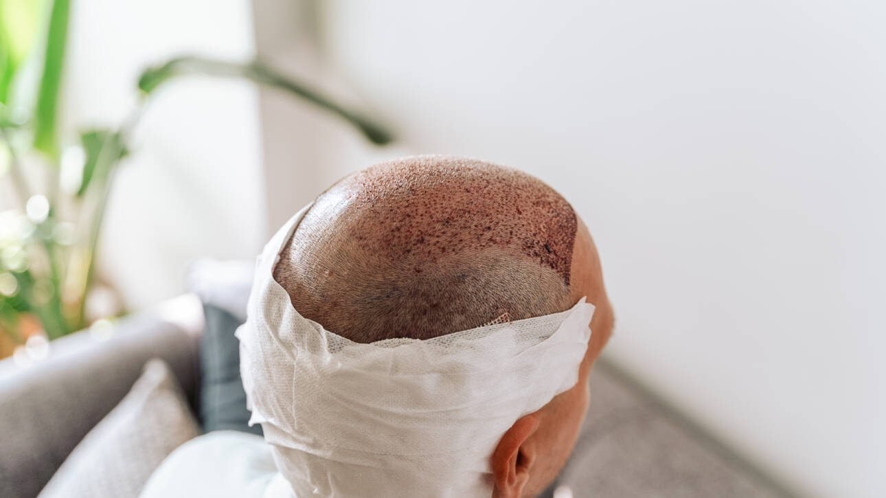 Can Scalp Micropigmentation Be Removed? Exploring Your Options