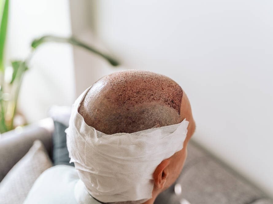 Can Scalp Micropigmentation Be Removed? Exploring Your Options