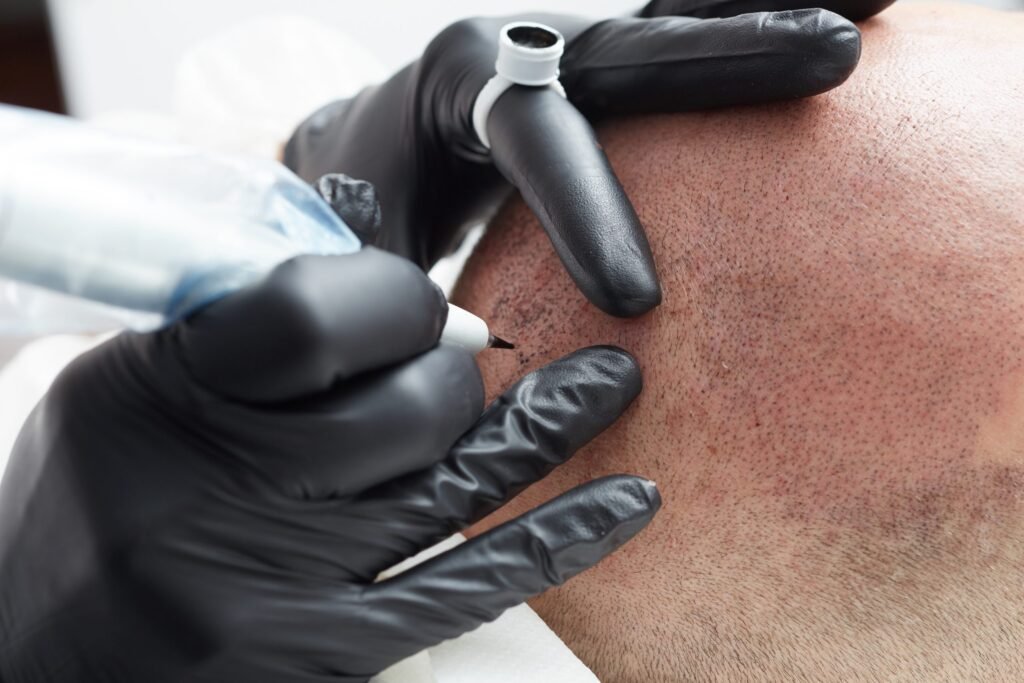 scalp-micropigmentation