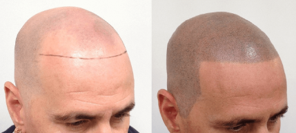scalp-micropigmentation-for-men