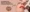 Lip Pigmentation Removal