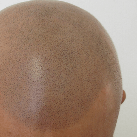 Does Scalp Micropigmentation Look Natural