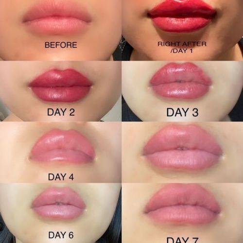 Day by day healing of Lips treatment