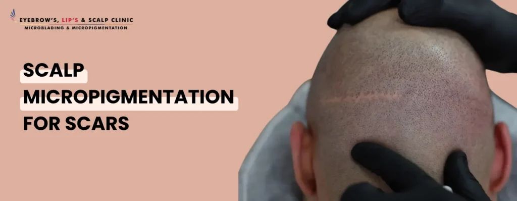 Scalp Micropigmentation for Scars