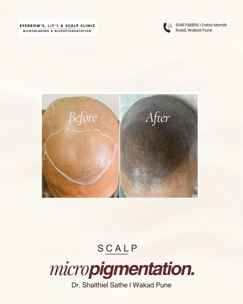 before and after scalp micropigmentation