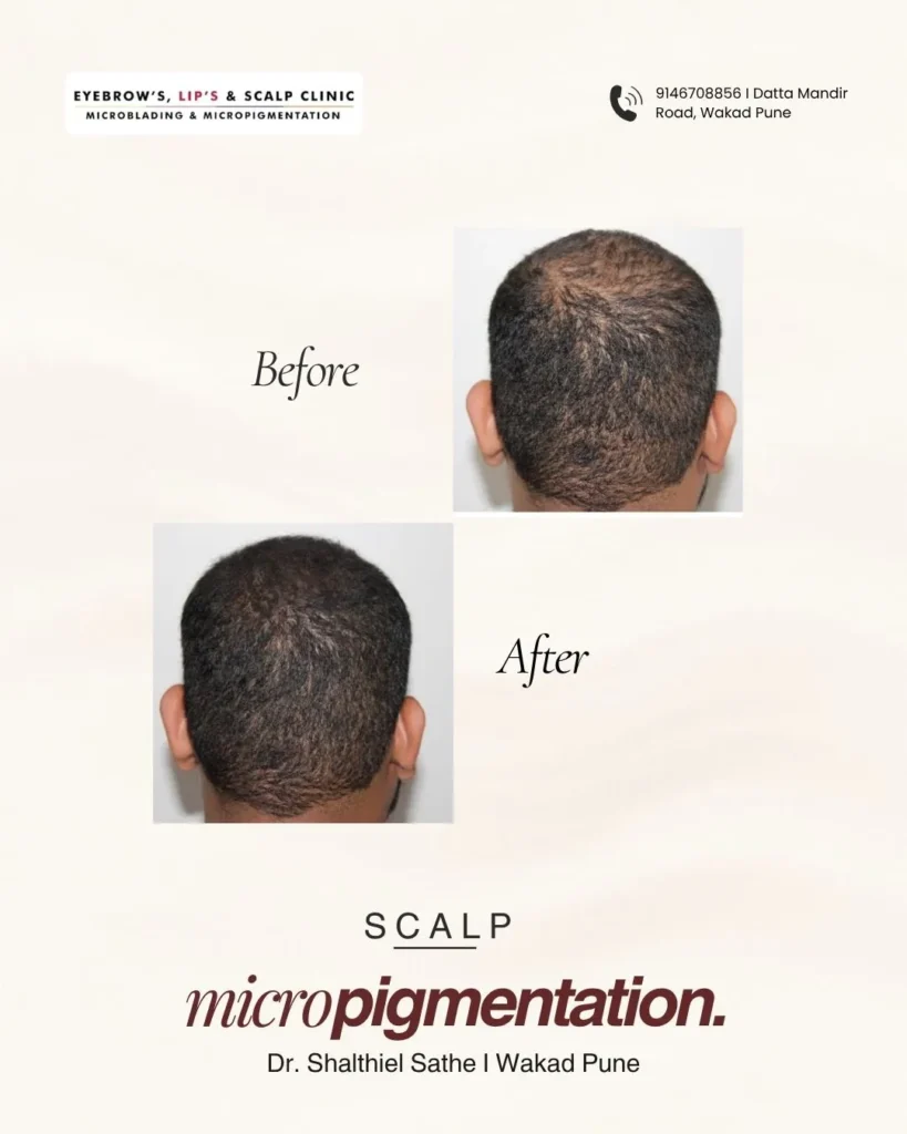 scalp micropigmentation close up​