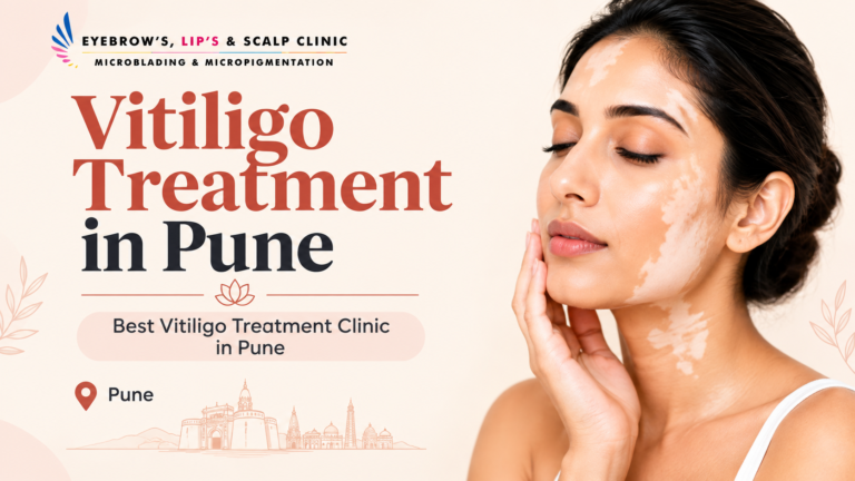 Vitiligo Treatment