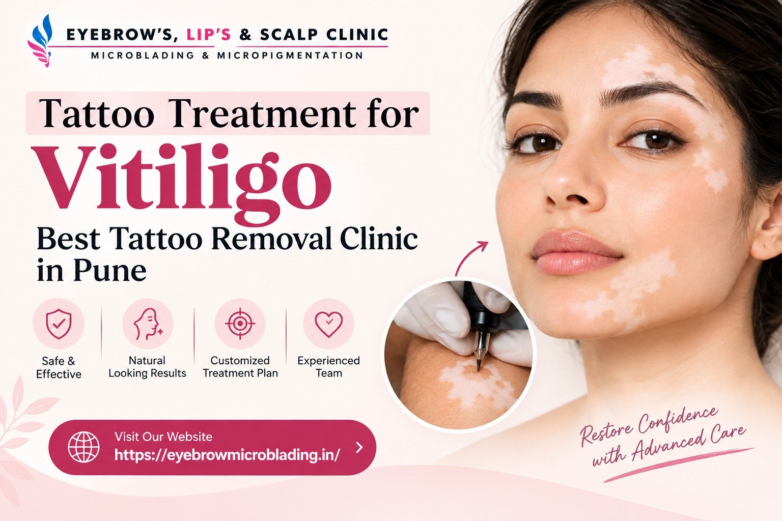 Tattoo Treatment for Vitiligo